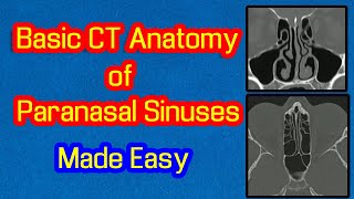 Basic CT Anatomy of Paranasal Sinuses Made Easy [upl. by Eidnahs]