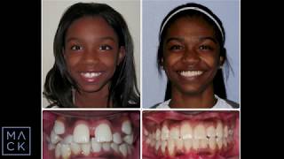 High Canines Corrected with Traditional Braces at Mack Orthodontics [upl. by Marian]