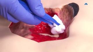 How to Effectively Cleanse and Debride a Wound  Wound Cleansing and Debridement  Ausmed Education [upl. by Junina]