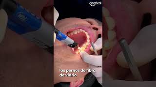 ¡Transformando Sonrisas 💫 Colocación de Perno de Fibra de Vidrio paso a paso 🦷 [upl. by Forlini]