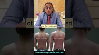 Pustular Psoriasis Homeopathic Treatment  70 Recovery in 1 Month  Before amp After Photos [upl. by Lerrad]