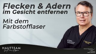 Rote Flecken und Adern im Gesicht entfernen mit Farbstofflaser [upl. by Araic]