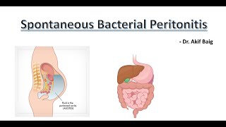 Spontaneous Bacterial Peritonitis  Dr Akif Baig [upl. by Kelam]