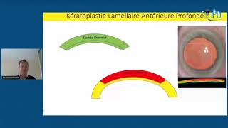 Kératocône en cas clinique congrès JPO 2021 [upl. by Oaks293]