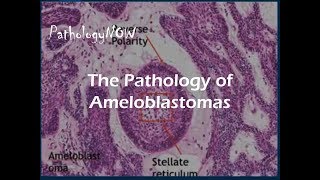 The Pathology of Ameloblastomas [upl. by Winfred]