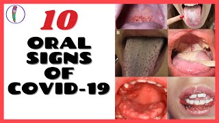 ORAL SIGNS OF CORONAVIRUS COVID 19  CORONAVIRUS SYMPTOMS [upl. by Htrahddis872]