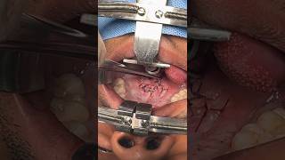 Double opposing z plasty and intra velar veloplasty to improve VPI and speech surgery [upl. by Evangelina]