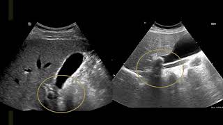 Focused Gallbladder Ultrasound [upl. by Lekzehcey]