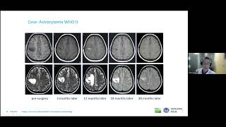 Minimally invasive techniques in brain oncology  D Ruess [upl. by Haimarej]