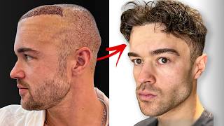 6 Month Hair Transplant Journey Full Recovery [upl. by Oderf]