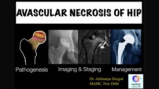 AVASCULAR NECROSIS OF HIPClinicoradiological discussionDetailed review of Imaging amp Staging of AVN [upl. by Sunil]