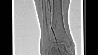 Angiography  Lower Extremities RSMDSA [upl. by Nodle]