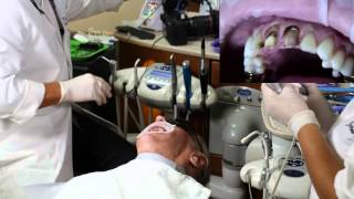 Part 1 Removal of Anterior PFM Crowns 4K Ultra HD [upl. by Ewold]