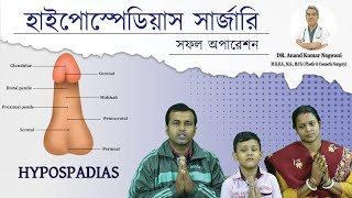 Hypospadias  প্রস্রাব সঠিক জায়গায় না খোলার সমস্যা  Hypospadias Repair in India  Dr Nagwani [upl. by Verge]