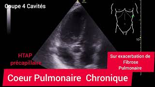 Coeur Pulmonaire Chronique HTAP Précapillaire Échographie [upl. by Atinob]