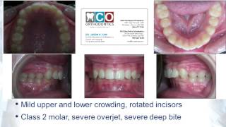 Best Invisalign Result Class 2 overjet overbite fixed  Toronto Orthodontist Dr Tam in Las Vegas [upl. by Hoi]