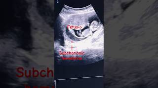 Subchorionic Hematomasubchorionic hemorrhage  1st trimester ultrasound ytshorts baby pregnancy [upl. by Attikin975]