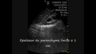 Hydronephrose severe Echographie de poche aux urgences [upl. by Nayve816]