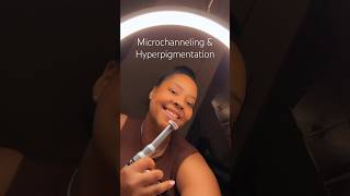 Microchanneling with Procell to target hyperpigmentation and strengthen the skin [upl. by Parent]