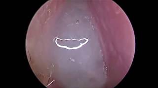 Huge Antrochoanal Polyp [upl. by Agnimod]