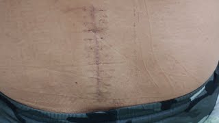 reason of spinal injuries L5 S1 Disc bulge Rod implant In Disc Disc Break after disc surgery [upl. by Ynafit]