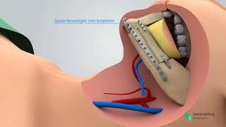 Herstel onderkaak [upl. by Oflunra916]