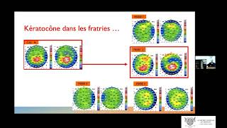 Réhabilitation chirurgicale du kératocone  Surgical rehabilitation of Keratoconus [upl. by Robina460]