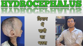 Hydrocephalus A killer disease Hindi  Symptoms amp surgeries  Dr Manish Mishra  Neurosurgeon [upl. by Harle176]