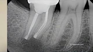 Reimplante Intencional  ENDODONCIA AVANZADA [upl. by Amerd155]