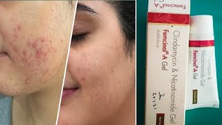 Femcinol A Gel review  Femcinol A Skin Gel  7 दिन मे फर्क पिंपल के दाग भी चले जाते है femcinol a [upl. by Eessac]