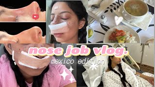 I GOT A RHINOPLASTY IN MEXICO [upl. by Maurita]