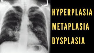 Hyperplasia Metaplasia amp Dysplasia Explained Cancer Biology [upl. by Marcile287]