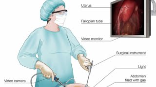 SURGICAL LAPAROTOMYSTAGESINDICATIONSPhysicsWallah [upl. by Esylle]