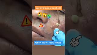 Cystic Acne Removal amp Inflammatory Acne [upl. by Stochmal]