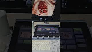 Fetal Echo  4 Chamber View  4D Ultrasound [upl. by Erdnassak]