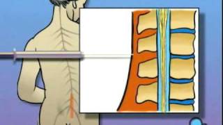 PreOp® Patient Education Spinal Anesthesia [upl. by Navy]