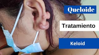 Queloide Oreja  Cicatriz Deformante  keloid [upl. by Atoiganap350]