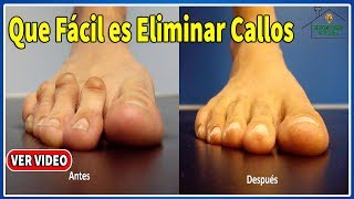 Que Fácil es Eliminar Callos en Pies y Manos Con Remedios Naturales [upl. by Assilam]