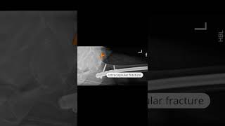 Intramedullary femoral nail with subcapital neck of femur fracture shoets [upl. by Ziwot]