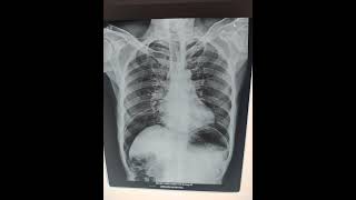 Peritonitis  pneumoperitoneum  chest x ray srivarihospital [upl. by Rayshell]