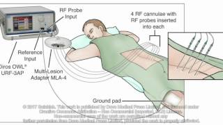 Introduction of an alternative radiofrequency technique for sacroiliac joint  Video Abstract 129478 [upl. by Amaerd]