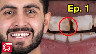 Treating ENAMEL Hypoplasia in The ANTERIOR Teeth Ep1 [upl. by Naj]