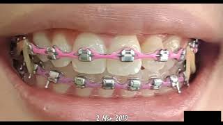 Trending Braces time lapse 2020  Damon braces for crooked teeth [upl. by Hnacogn]