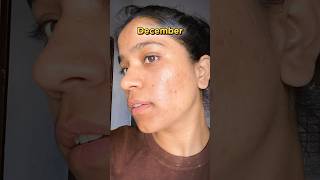 Tretinoin cream before and after  January to December Transformation  tretinoin acne face  🤫 [upl. by Packer203]