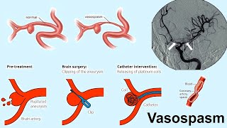 vasospasm [upl. by Llenel]