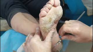 Cracked Heels So satisfying 9 mins Dead skin removal and Cracked heel treatment [upl. by Hoehne747]