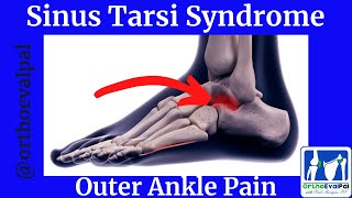 Sinus Tarsi Syndrome Outer Ankle Pain [upl. by Grewitz]