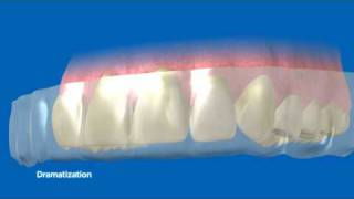 NEW Crest Whitestrips Advanced Seal  How it works [upl. by Leyameg]