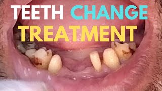 Teeth change treatment  missing teeth  front teeth replacement [upl. by Ottie]