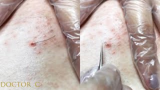 cleaning infected ingrown hair [upl. by Ynnad]